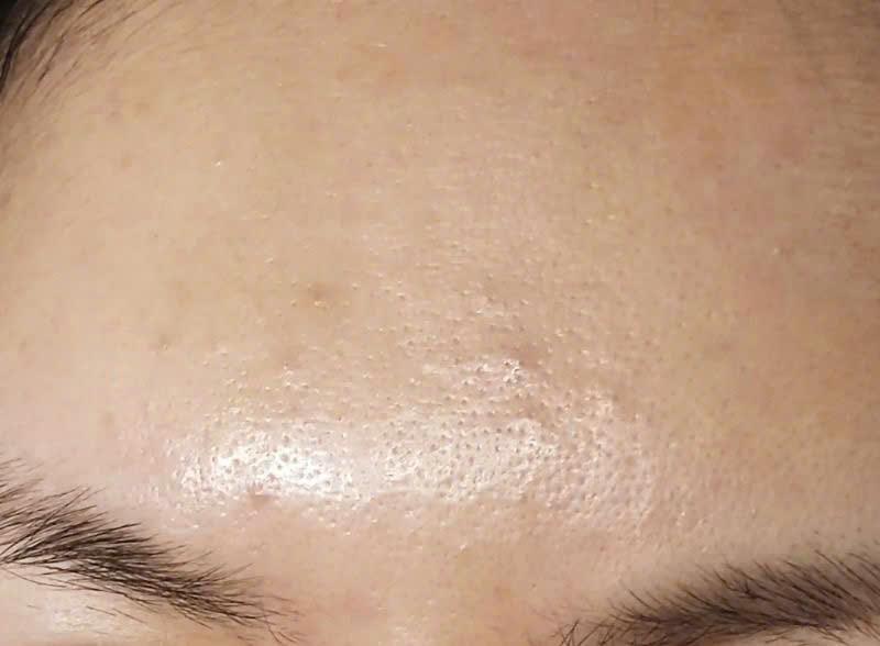 Trước và sau điều trị